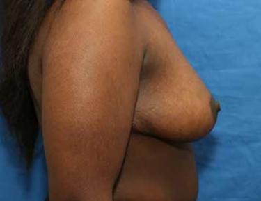 After Results for Breast Reduction