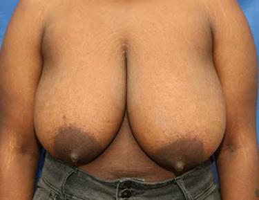 Before Results for Breast Reduction