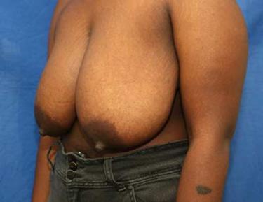 Before Results for Breast Reduction