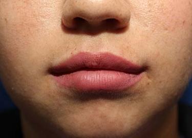 After Results for Tissue Fillers