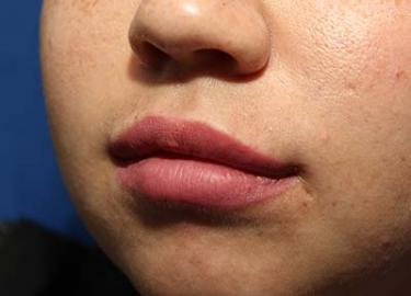 After Results for Tissue Fillers