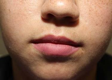 Before Results for Tissue Fillers