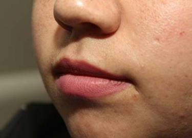 Before Results for Tissue Fillers