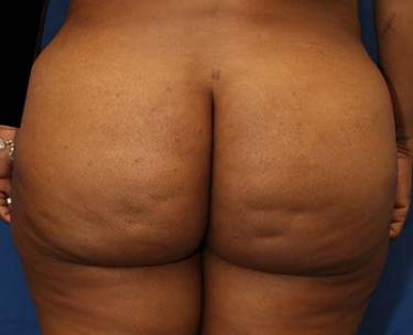 After Results for Brazilian Butt Lift / Gluteal Augmentation