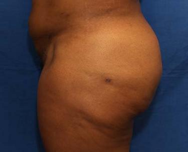 After Results for Gluteal Augmentation