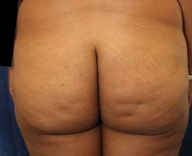 Before Results for Gluteal Augmentation