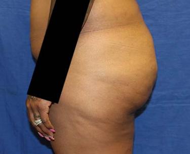 Before Results for Gluteal Augmentation