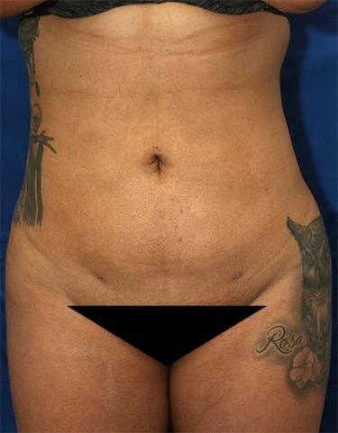 After Results for Liposuction