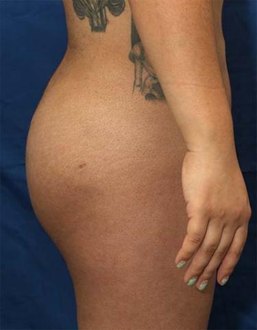 After Results for Liposuction