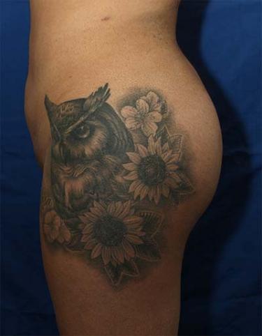 After Results for Liposuction