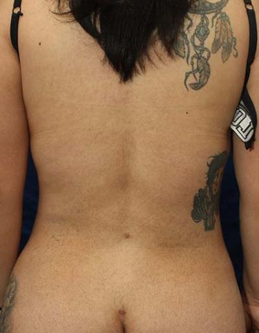 After Results for Liposuction