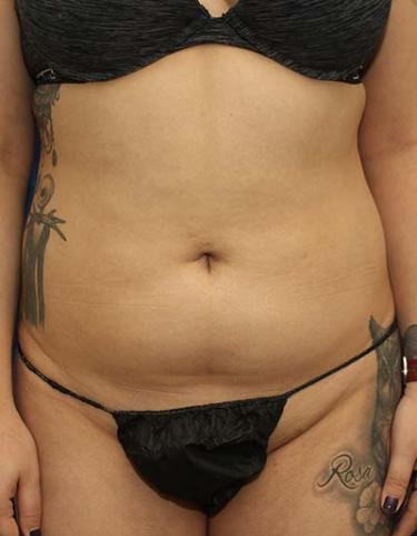 Before Results for Liposuction