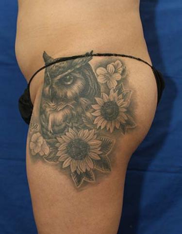 Before Results for Liposuction