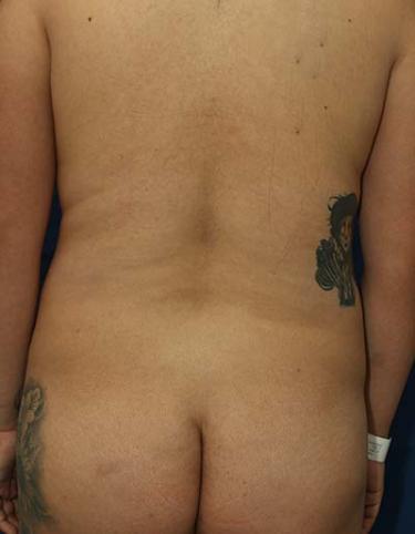 Before Results for Liposuction