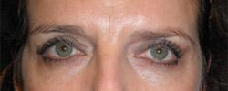 After Results for Blepharoplasty