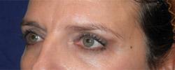 After Results for Blepharoplasty