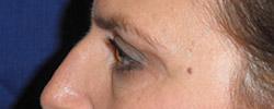 After Results for Blepharoplasty