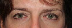 Before Results for Blepharoplasty