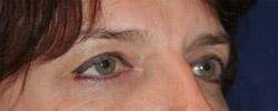 Before Results for Blepharoplasty