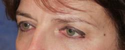 Before Results for Blepharoplasty