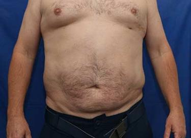 After Results for Liposuction