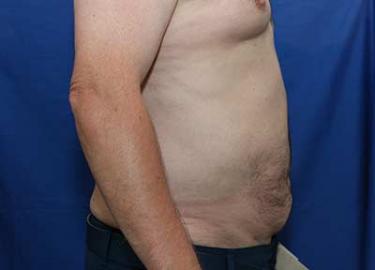 After Results for Liposuction