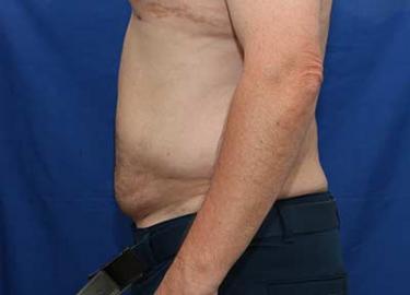 After Results for Liposuction