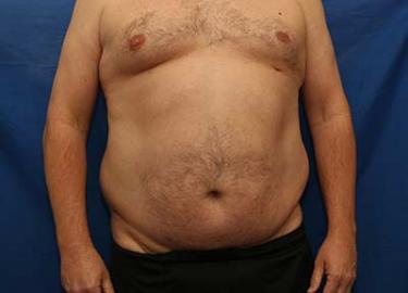 Before Results for Liposuction