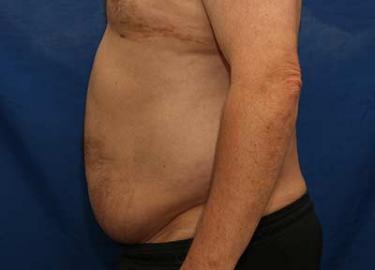 Before Results for Liposuction