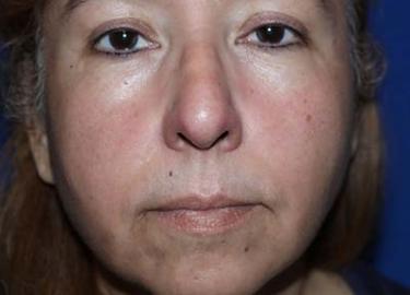 After Results for Tissue Fillers