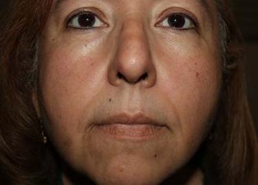 Before Results for Tissue Fillers