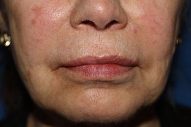 After Results for Tissue Fillers