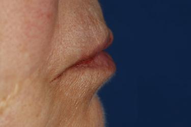 After Results for Tissue Fillers