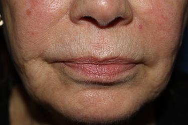 Before Results for Tissue Fillers