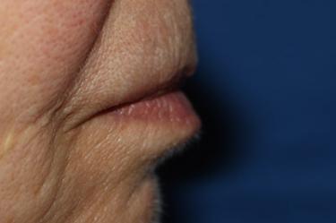 Before Results for Tissue Fillers