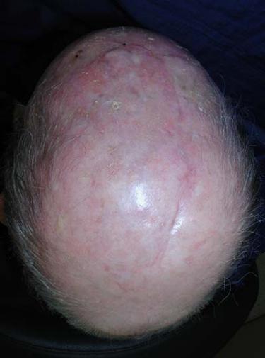 After Results for Wound Care