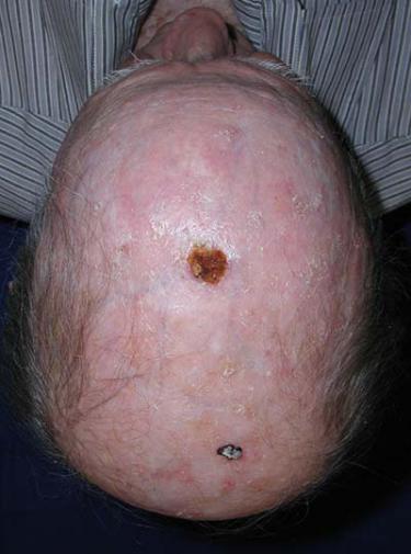 Before Results for Wound Care