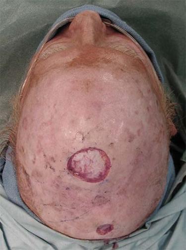 Before Results for Wound Care