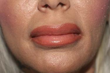 After Results for Tissue Fillers, Lip Augmentation