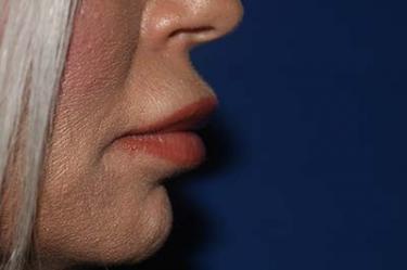 After Results for Tissue Fillers, Lip Augmentation
