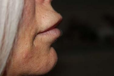 Before Results for Tissue Fillers, Lip Augmentation