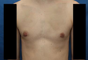 After Results for Gynecomastia