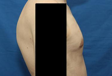 After Results for Gynecomastia