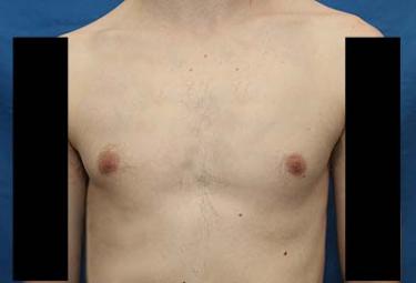 Before Results for Gynecomastia