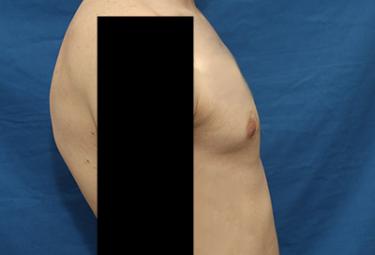 Before Results for Gynecomastia