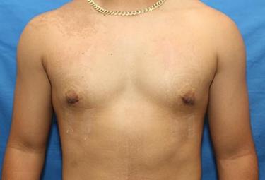 After Results for Gynecomastia