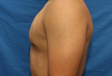 After Results for Gynecomastia