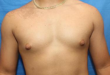 Before Results for Gynecomastia