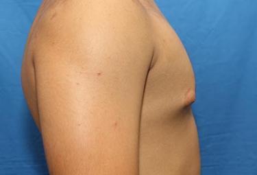 Before Results for Gynecomastia