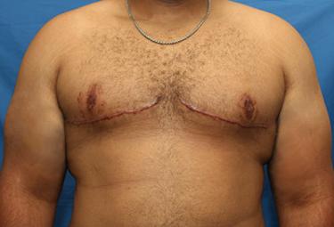 After Results for Gynecomastia